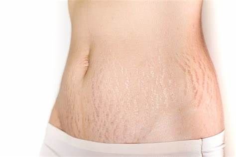 Stretch Mark Camouflage